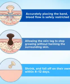 Mresio® Skin Tag Removal Kit