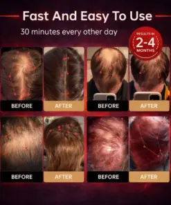 Mresio® Red Light Cap — Regrow Hair, Reduce Shedding