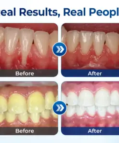 Mresio® RegenDent Advanced Tooth & Gum Renewal Device
