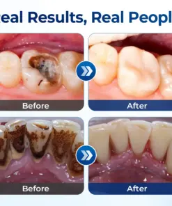 Mresio® RegenDent Advanced Tooth & Gum Renewal Device